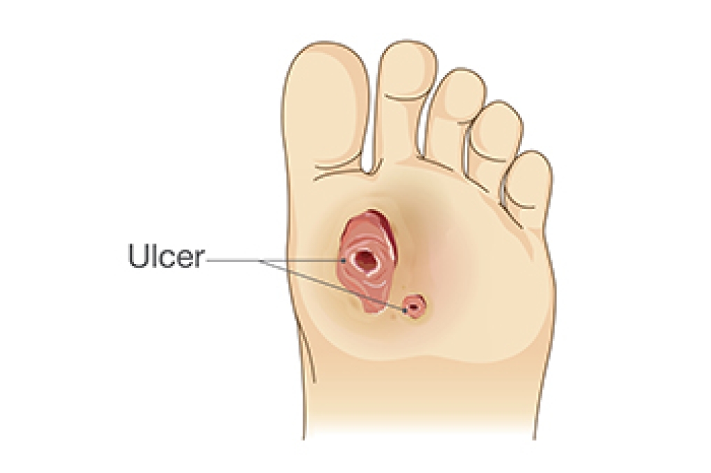 Early Care Matters for Diabetic Foot Ulcers