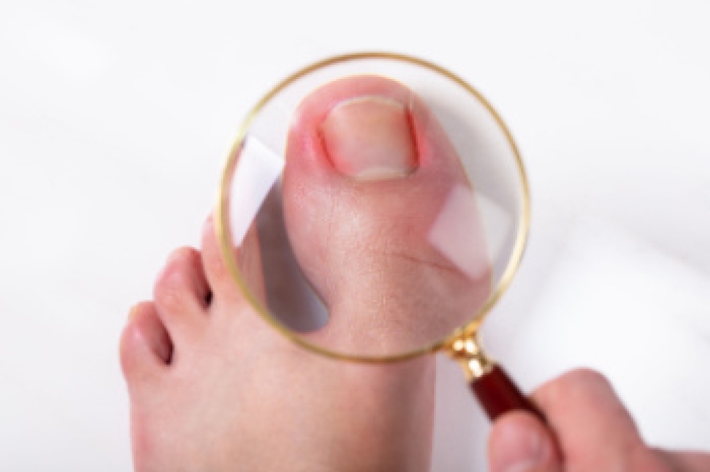 What Causes an Ingrown Toenail?