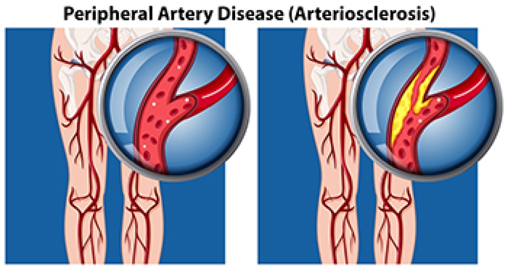 Cold Feet Can Signal Peripheral Artery Disease