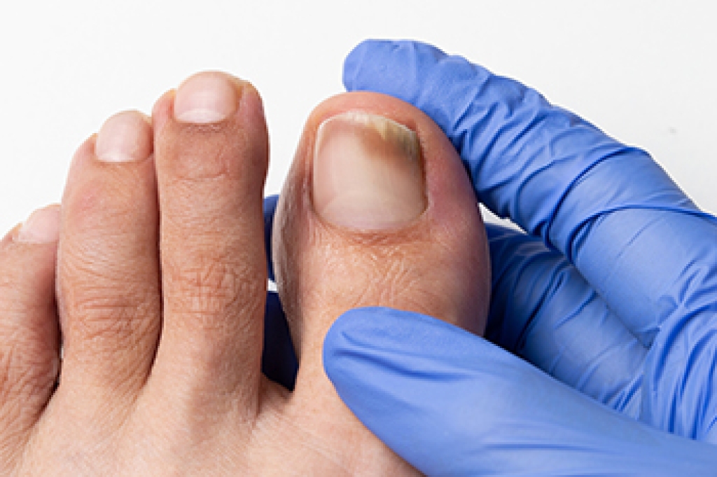 Toenail Fungus Explained