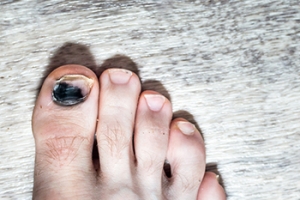 Causes and Treatment of Tennis Toe