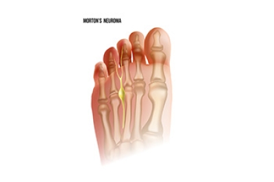 Morton's Neuroma and How to Find Relief